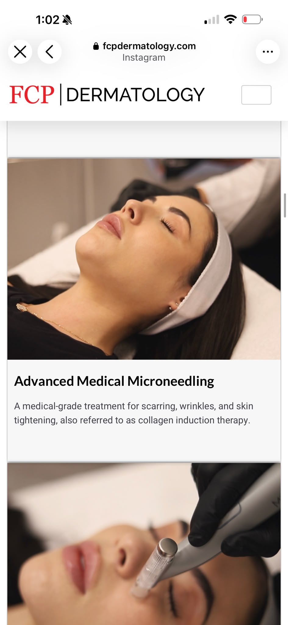 Collagen Induction